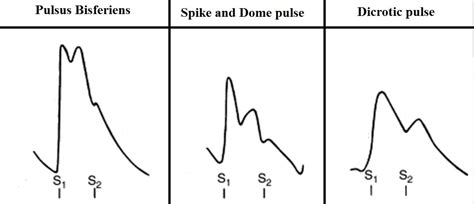 spike and dome|pulsus bisferiens.